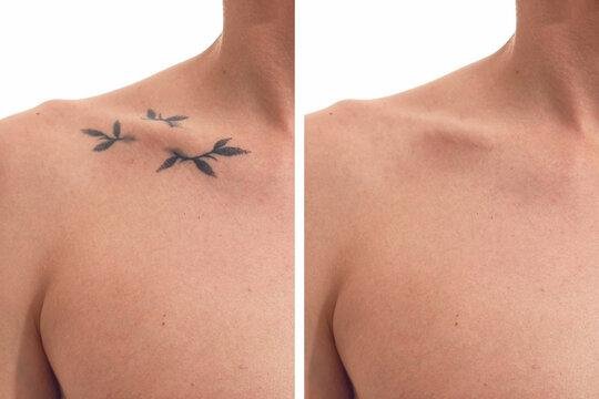 Laser tattoo removal after