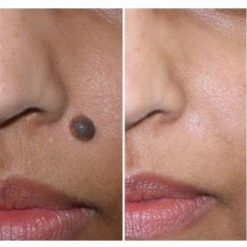 Mole removal after