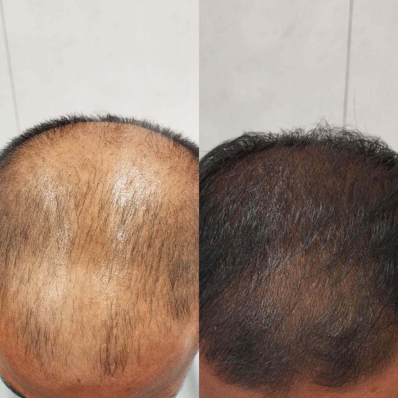 Advanced hair restoration PRP after