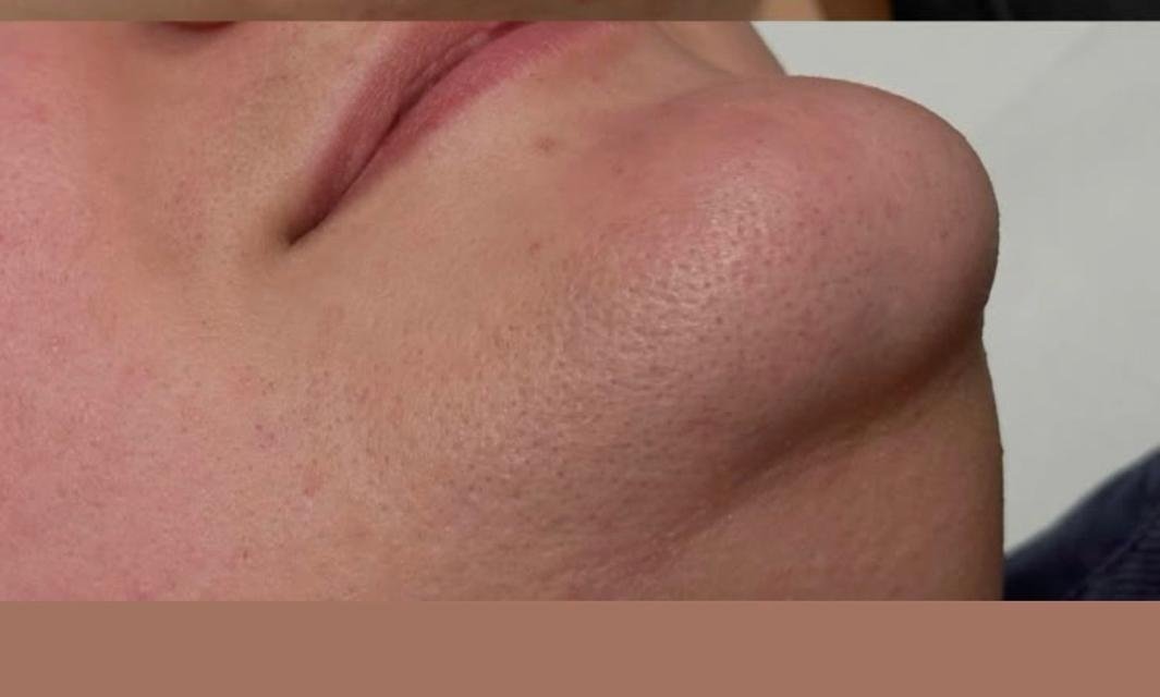 Laser hair reduction chin after