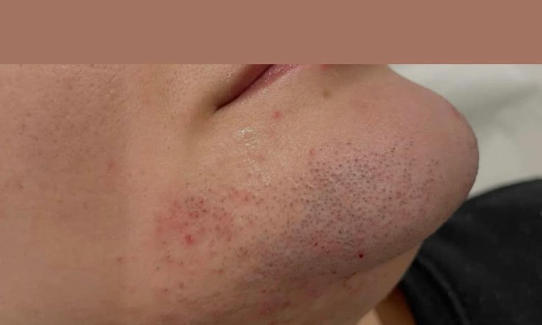 Laser hair reduction chin before