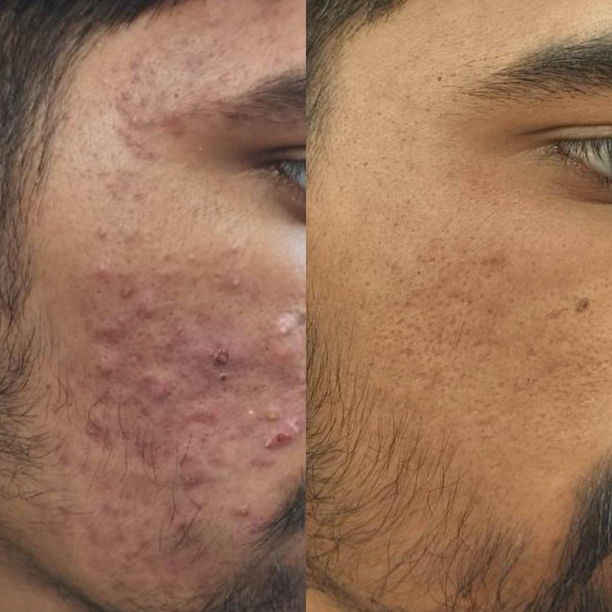 Acne scars treatment after results at Sindhu Skin Clinic