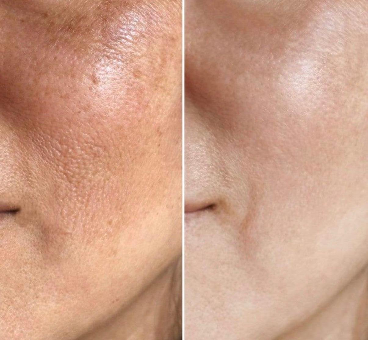 Dermatology skin treatment after results at Sindhu Skin Clinic