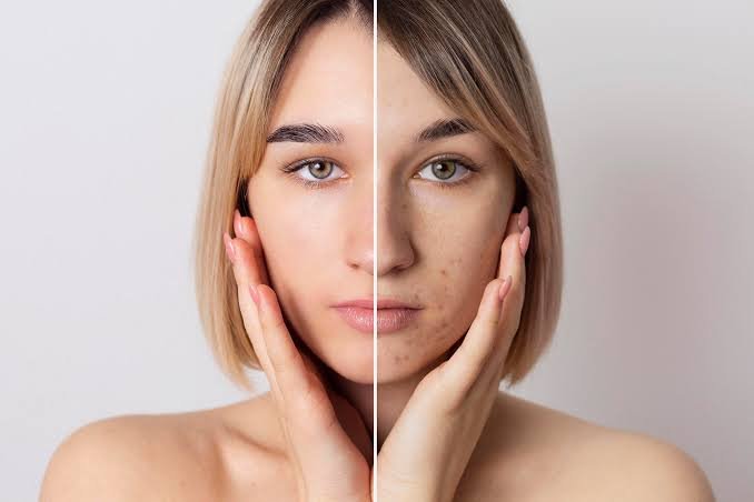 Pigmentation correction at Sindhu Skin & Hair Clinic in Washim