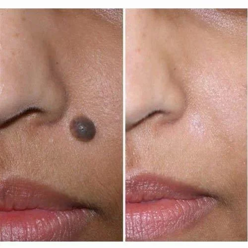Pigmentation treatment after
