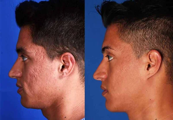 Acne treatment after